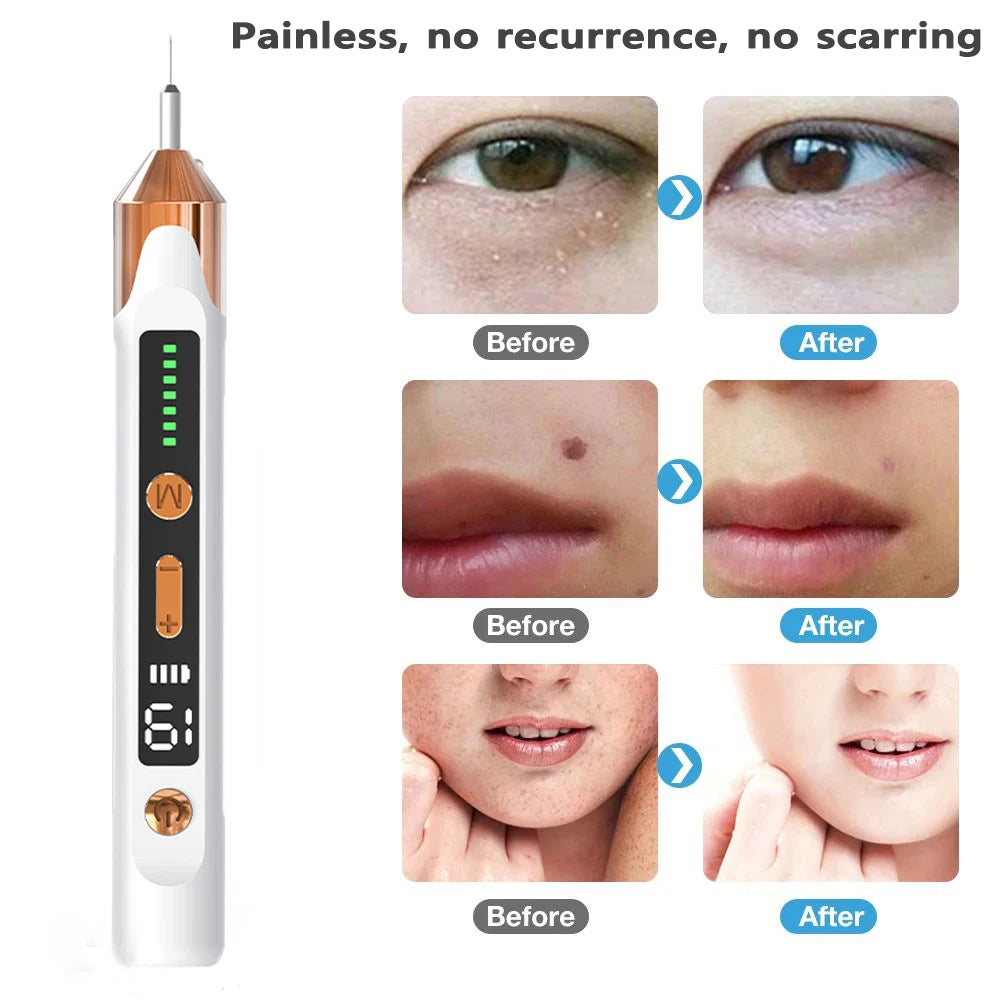 Laser Plasma Pen for Skin Tag Remover Freckle Black Dot Eliminator Papilloma  Mole Pimples Wart Tattoo Removal Plasma Pen