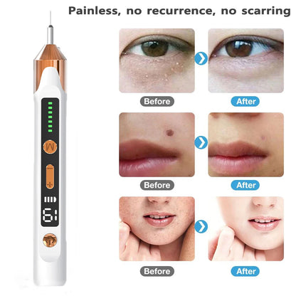 Laser Plasma Pen for Skin Tag Remover Freckle Black Dot Eliminator Papilloma  Mole Pimples Wart Tattoo Removal Plasma Pen