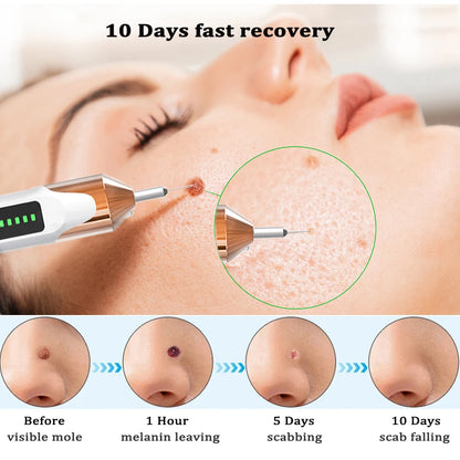 Laser Plasma Pen for Skin Tag Remover Freckle Black Dot Eliminator Papilloma  Mole Pimples Wart Tattoo Removal Plasma Pen